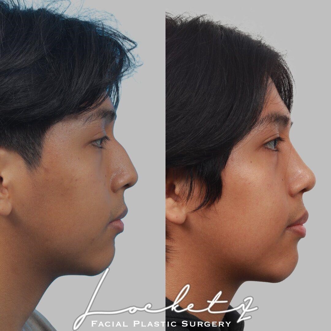 revision rhinoplasty expert los angeles