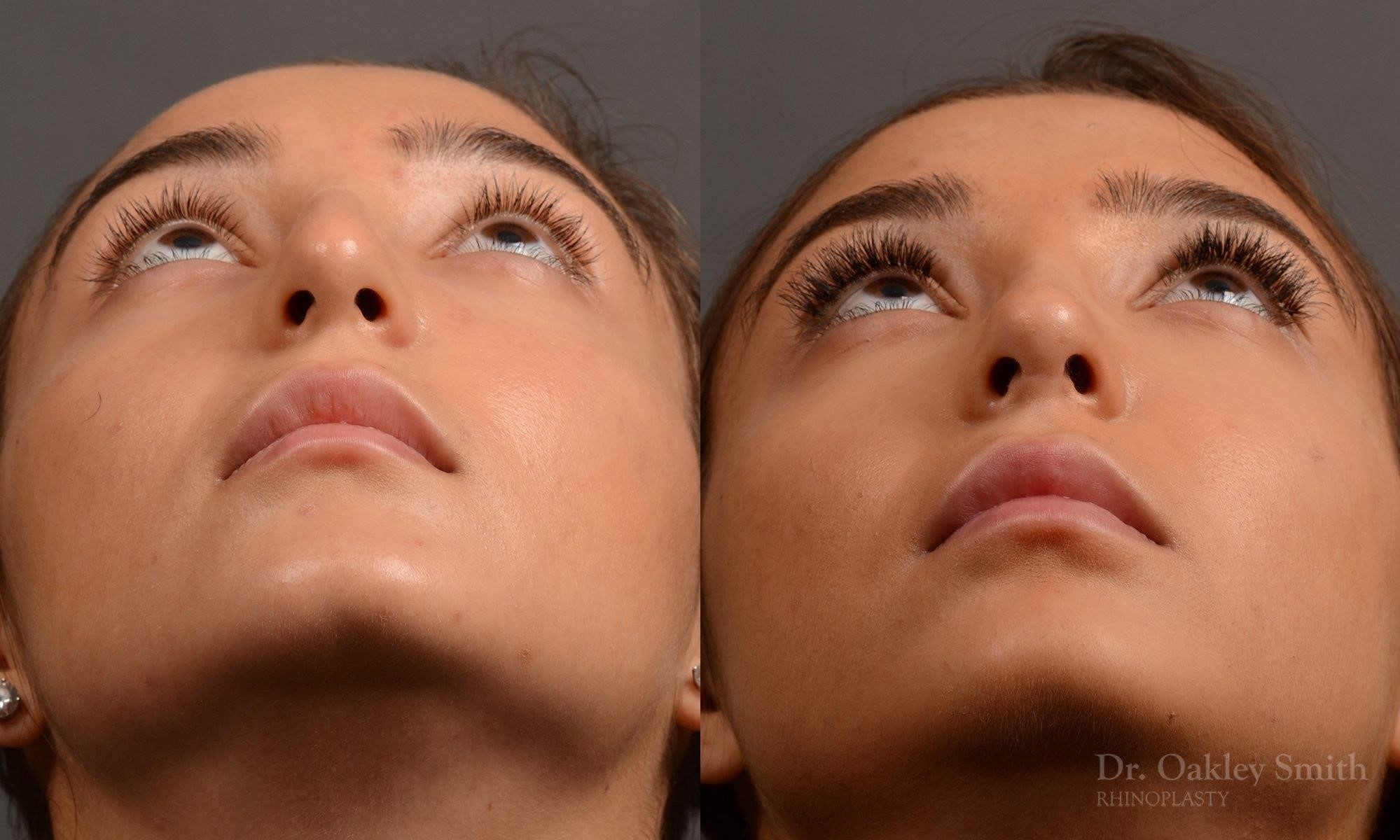 what is rhinoplasty surgery