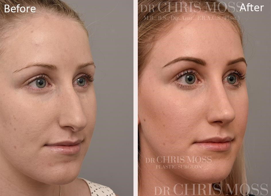 revision rhinoplasty expert los angeles