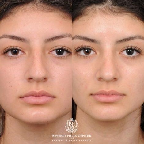 what is rhinoplasty surgery