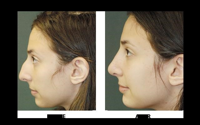 revision rhinoplasty expert los angeles