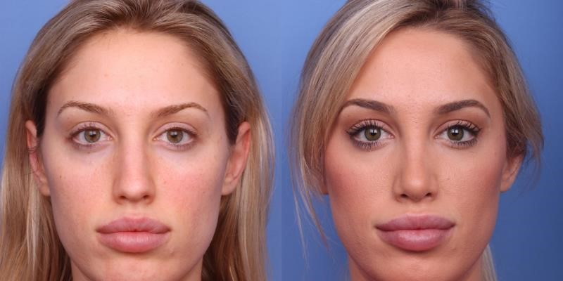 revision rhinoplasty expert los angeles