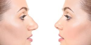 what is rhinoplasty surgery