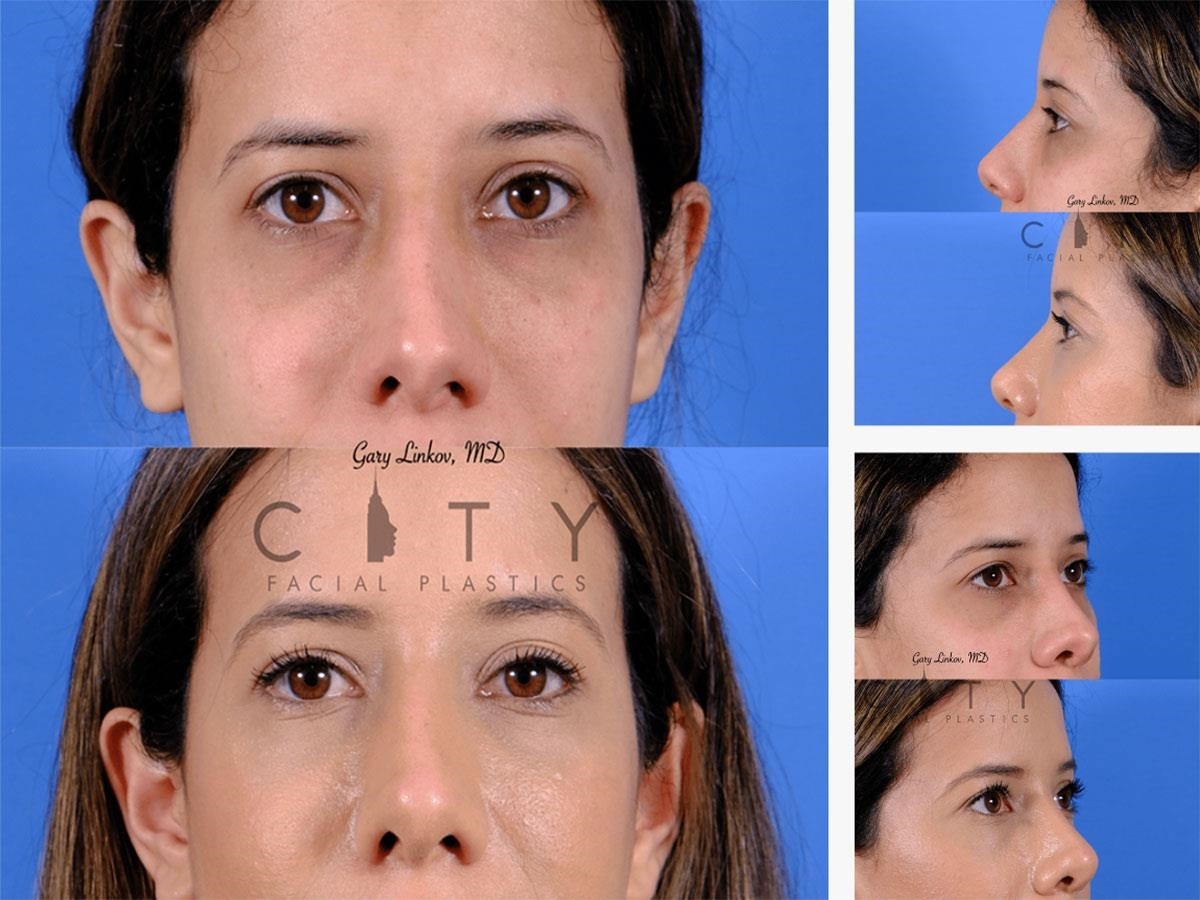 revision rhinoplasty expert los angeles